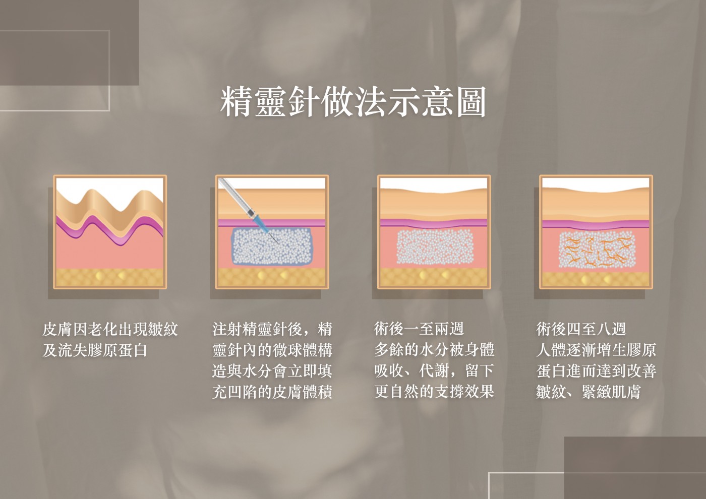 精靈針做法示意圖