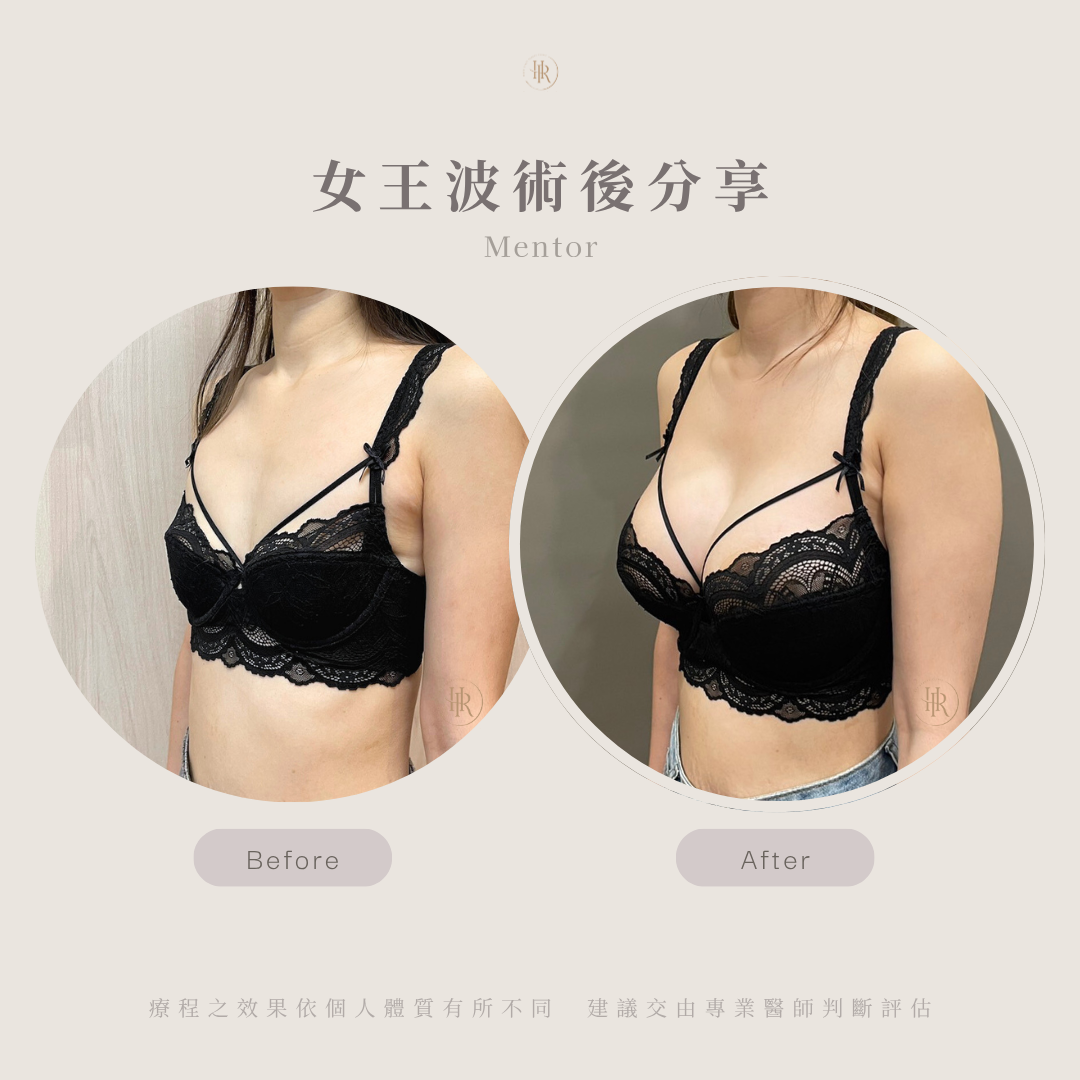 女王波術後對比照