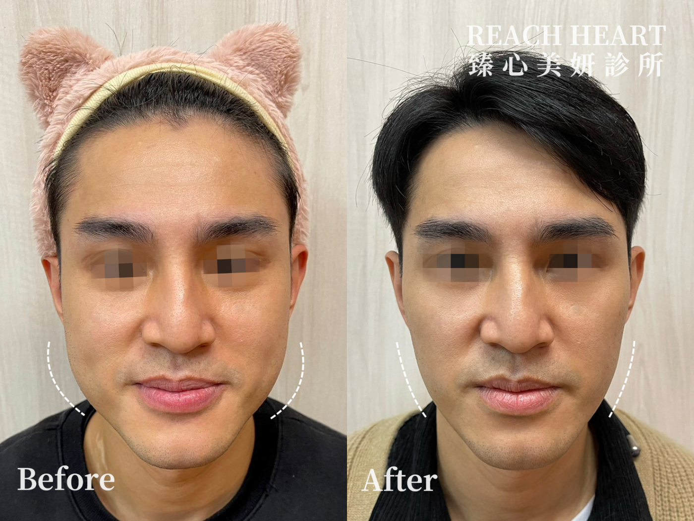 肉毒案例照_小臉