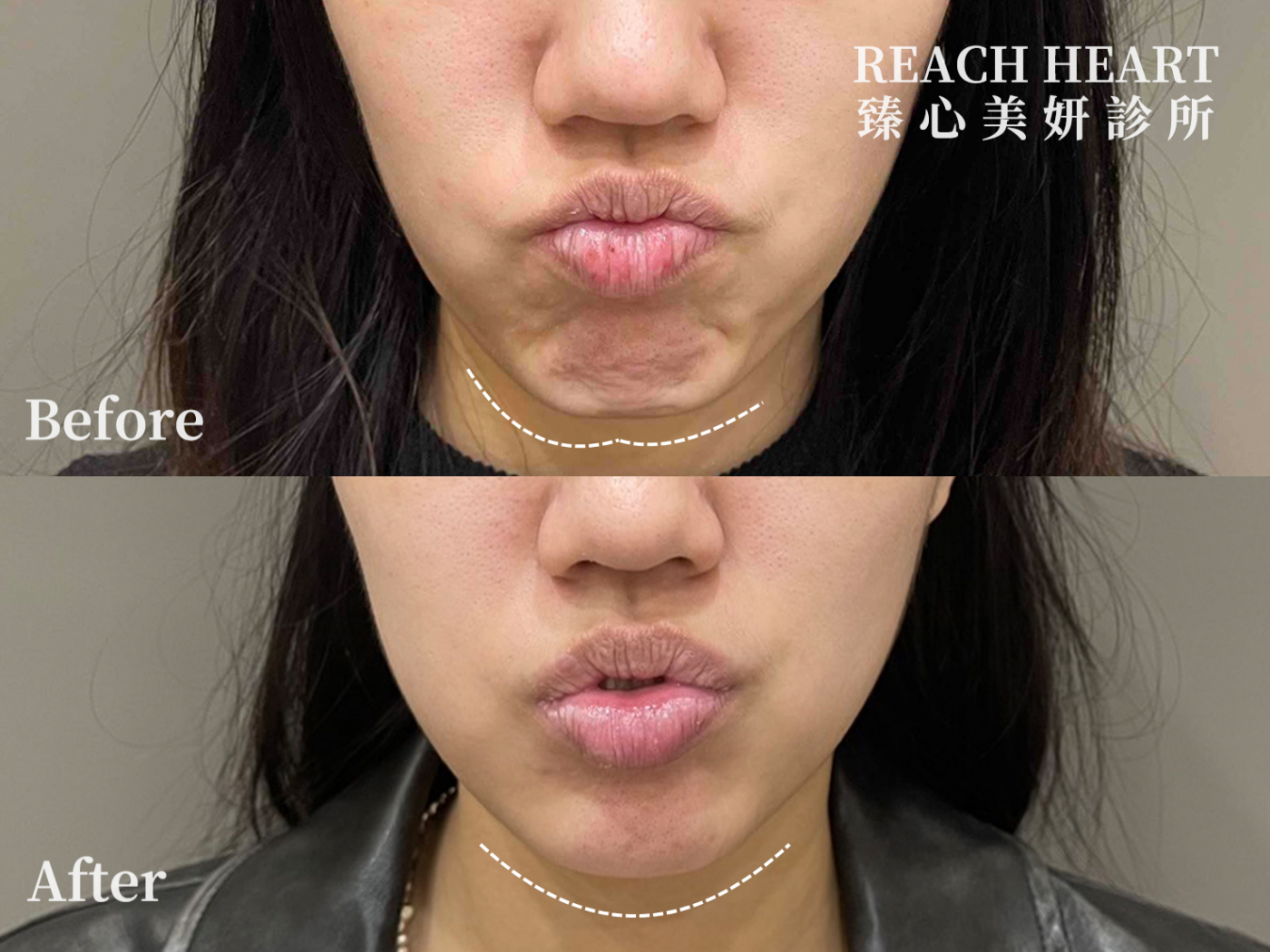 肉毒案例照_下巴