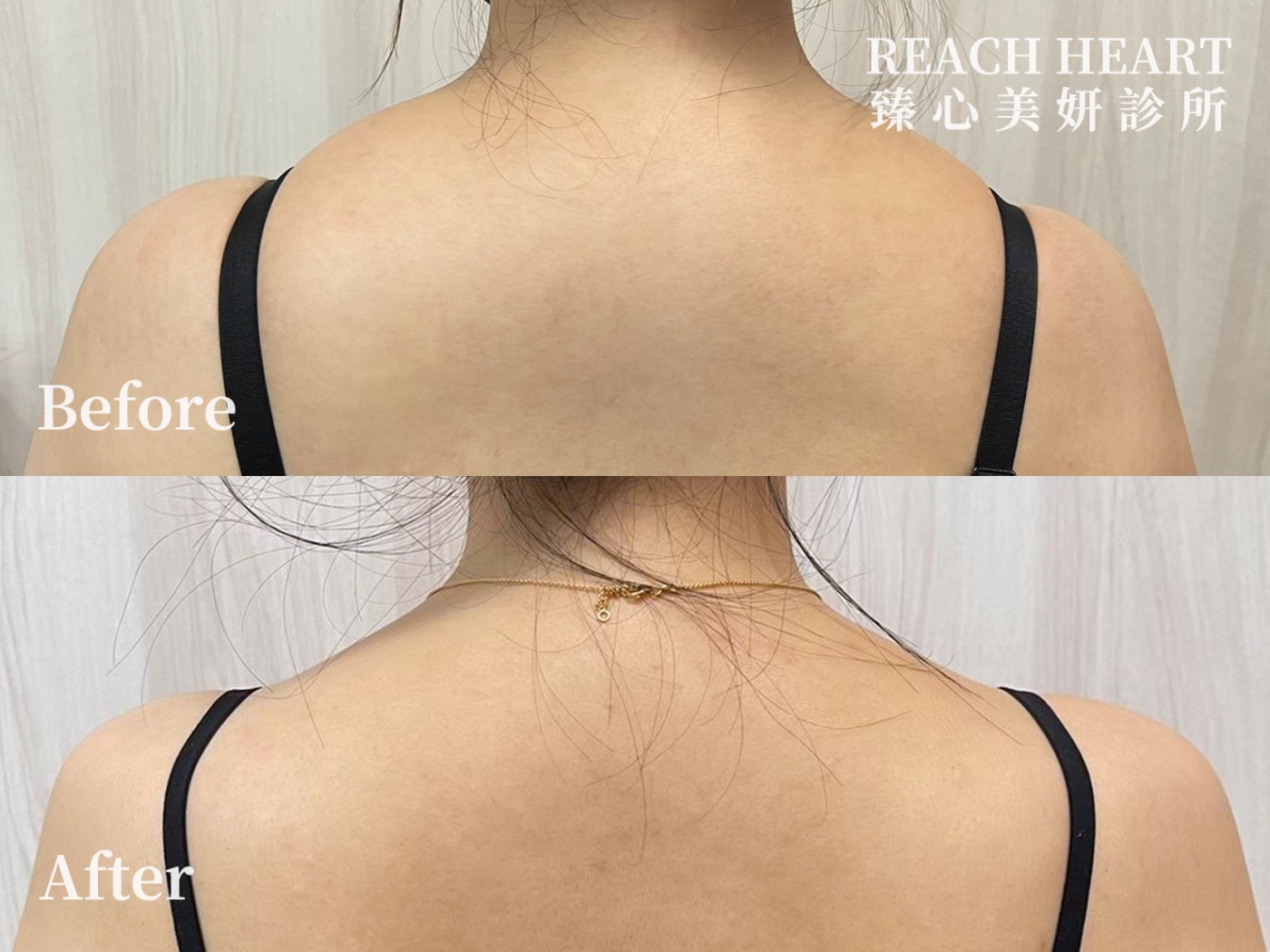 肉毒案例照_肩膀