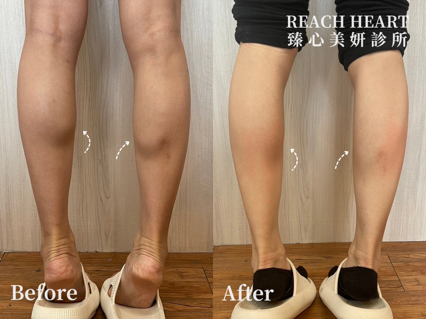 肉毒案例照_小腿