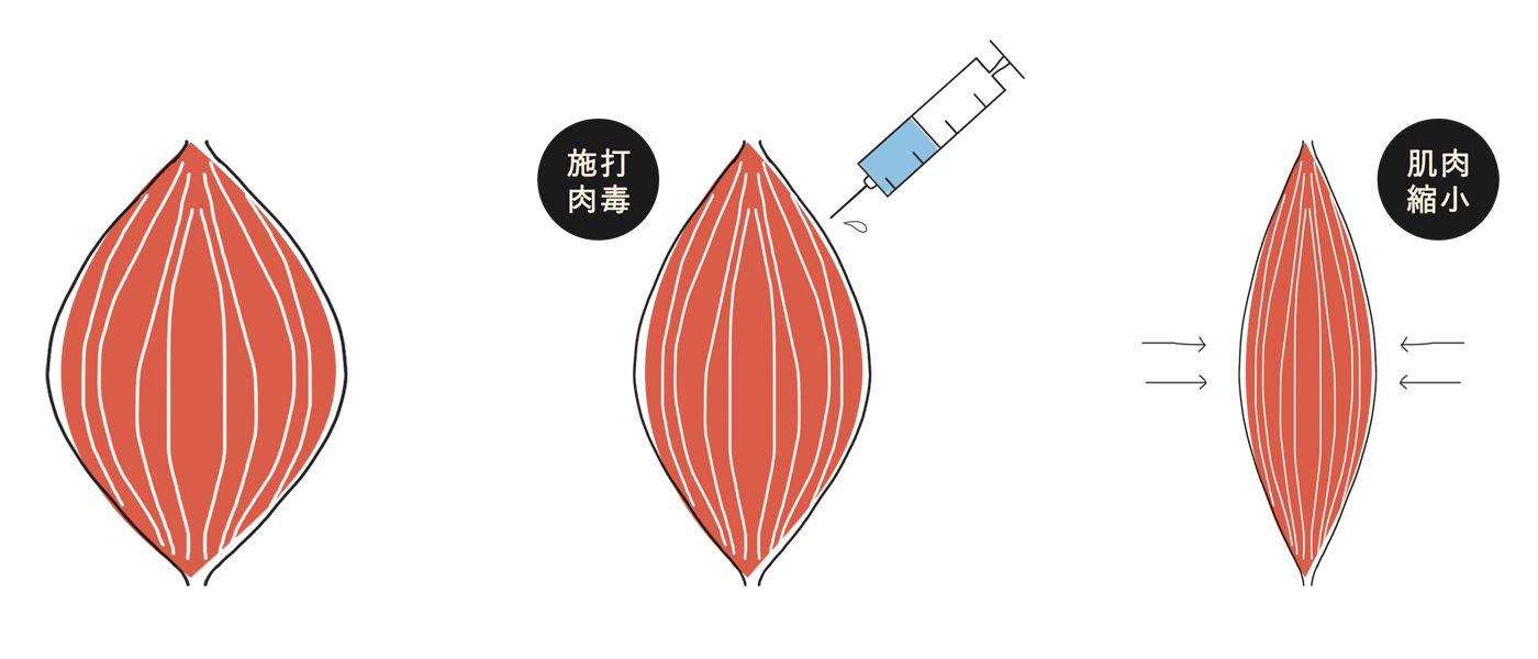 肉毒作用原理