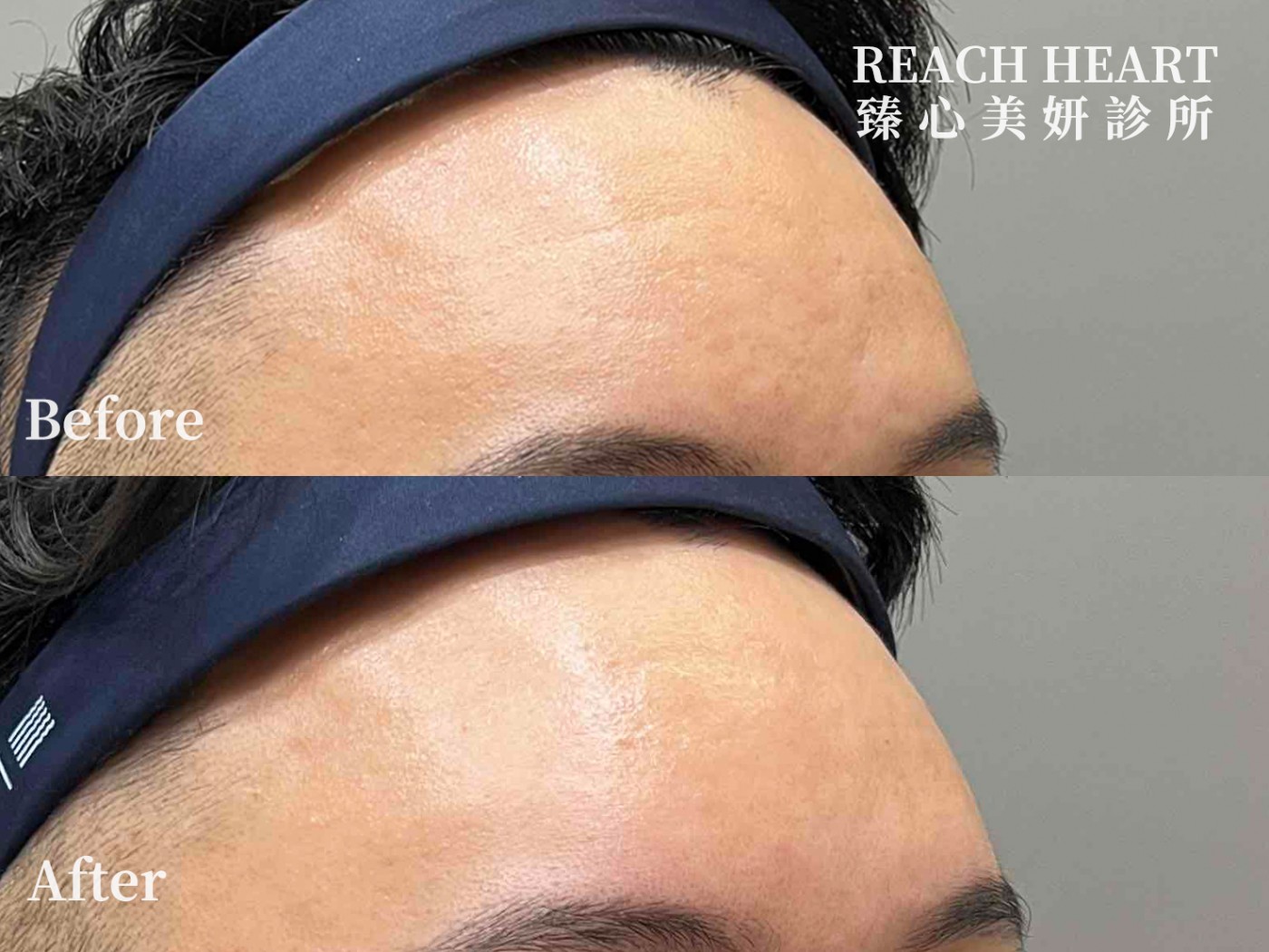 得美微針筆案例01