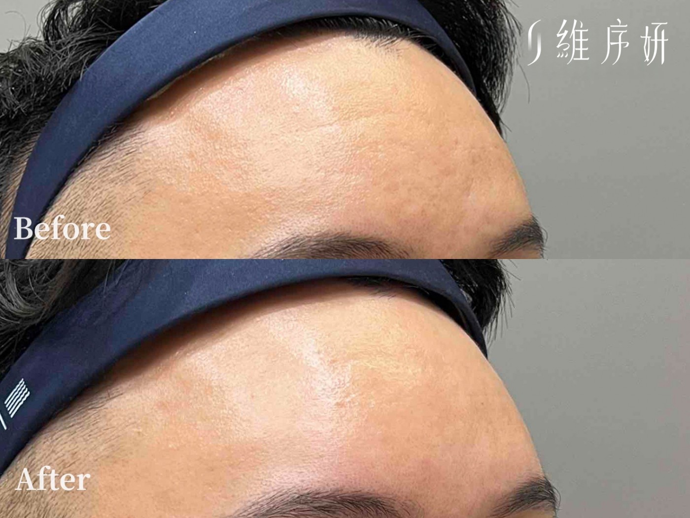 得美微針筆案例01